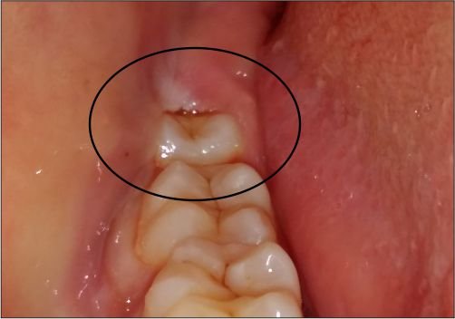 Braces & Aligners in Rajkot: Gentle, Effective Smiles