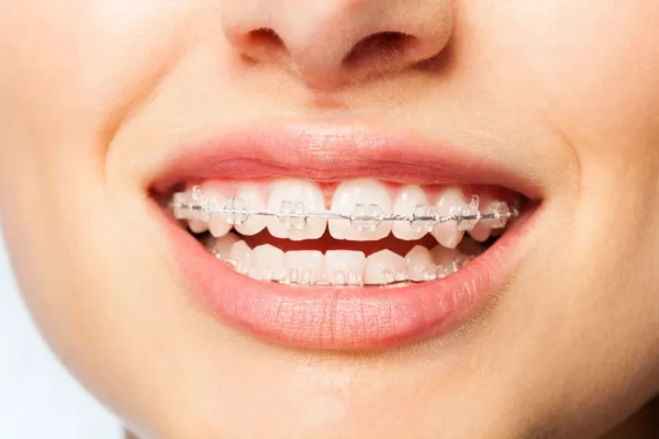 Transparent Invisalign Cost Guide: What to Expect