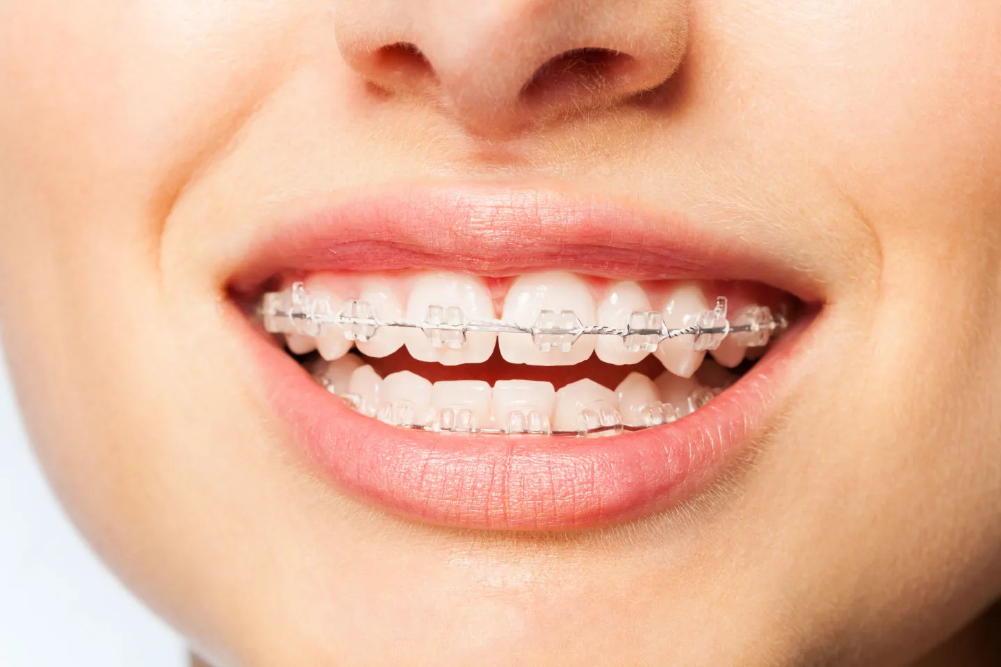 Transparent Invisalign Cost Guide: What to Expect