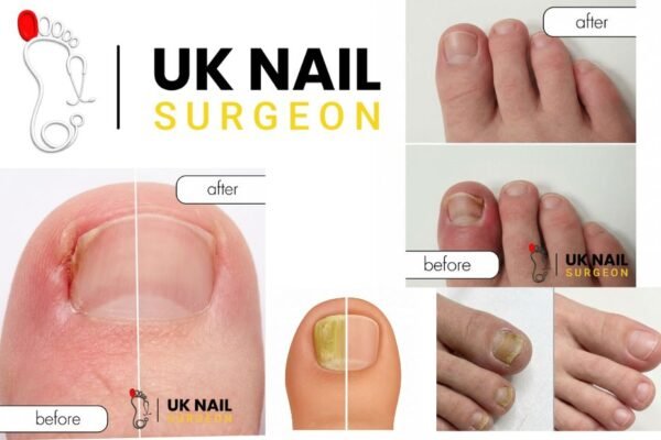 How to Tackle Fungal Nails: Expert Care & Clear Results