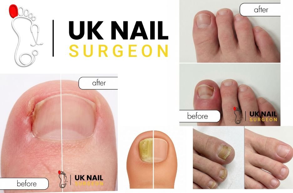 How to Tackle Fungal Nails: Expert Care & Clear Results