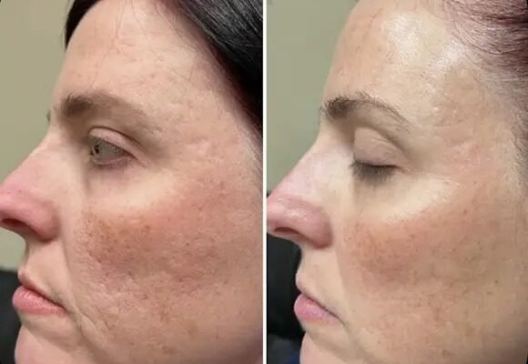 Effective Stretch Mark Treatments in Milton for Smoother Skin