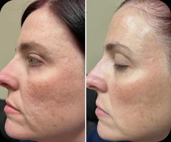 Effective Stretch Mark Treatments in Milton for Smoother Skin