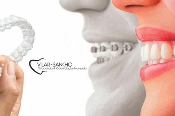 Sonrisa perfecta en Pozuelo: ortodoncia de confianza