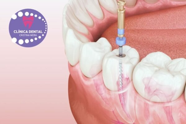 La millor solució d’implant dental a Gines
