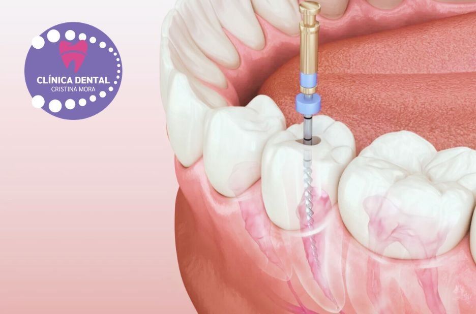 La millor solució d’implant dental a Gines