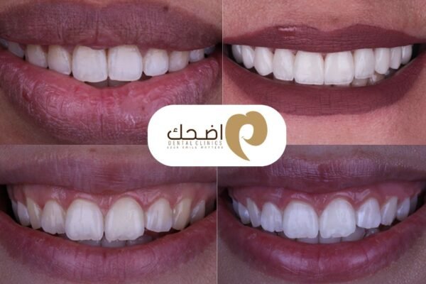 ابتسامة أكثر بياضاً باستخدام تقنية الليزر الآمنة
