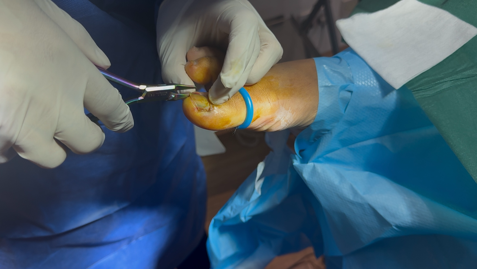 Expert fungal nail treatment in Birmingham | specialised care