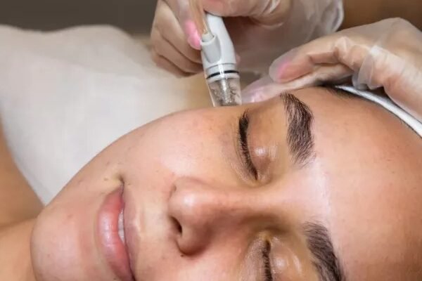Professional Milia Treatments in Oakville for Clearer Skin
