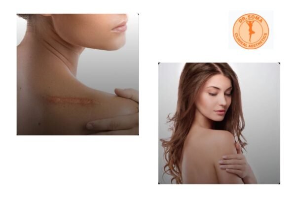 Effective Keloid Solutions in Southeast Asia: Expert Care