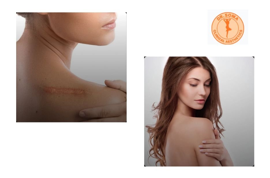 Effective Keloid Solutions in Southeast Asia: Expert Care