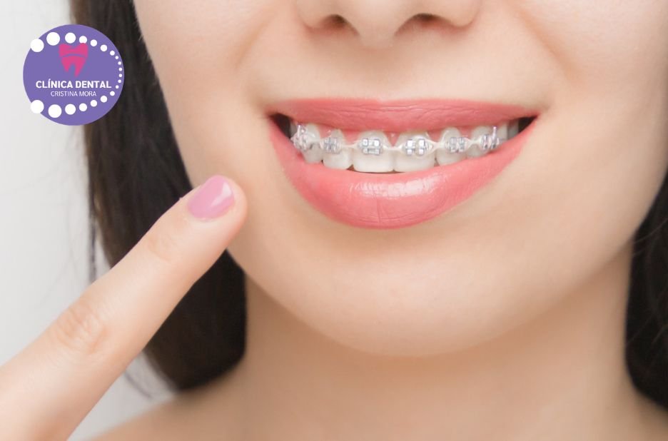 Sorrís amb confiança: implants dentals a Gines