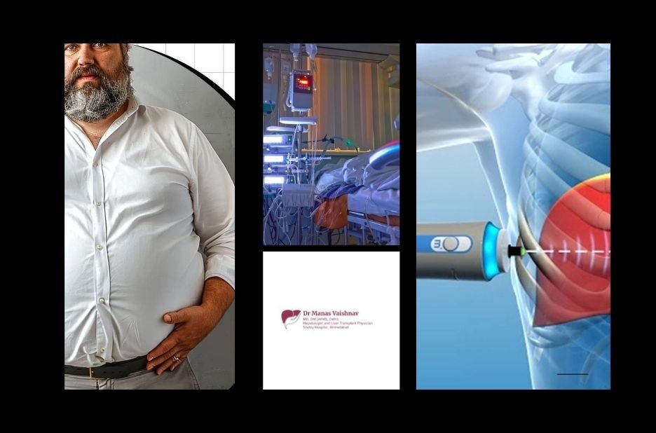 Top Liver Transplant in Ahmedabad and Gujarat | Expert Hepatology Care
