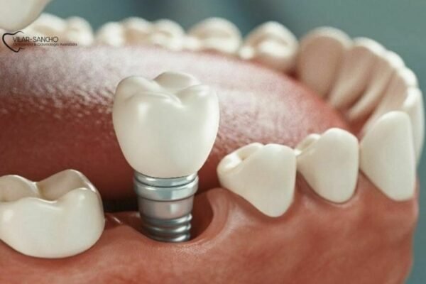 Hidden Braces: Subtle Orthodontics Near You in Pozuelo de Alarcón