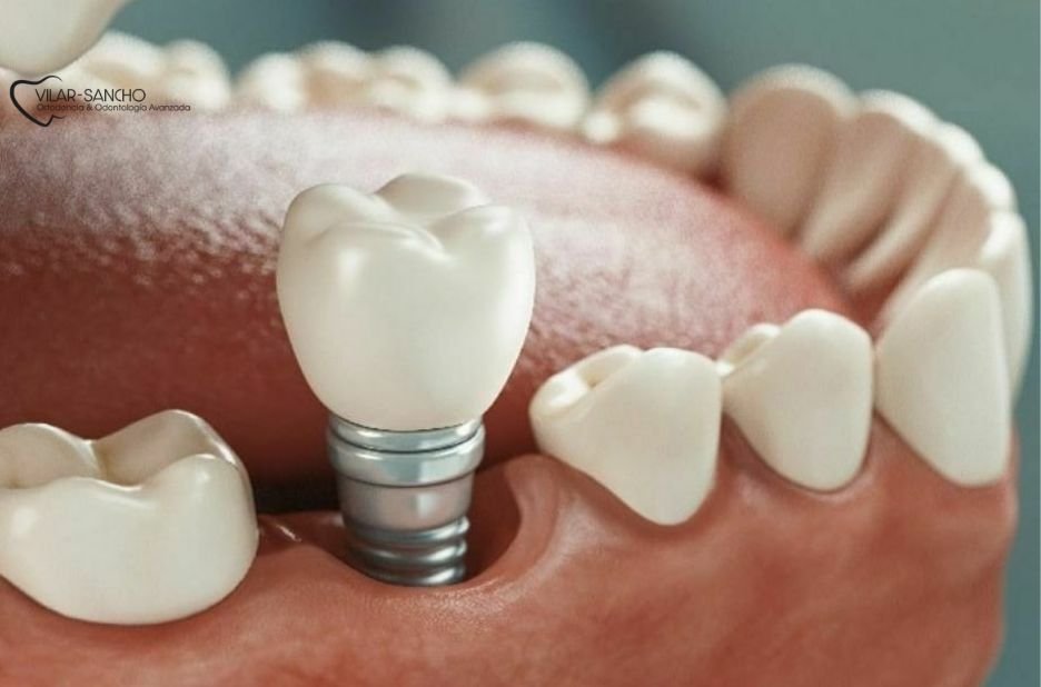 Hidden Braces: Subtle Orthodontics Near You in Pozuelo de Alarcón