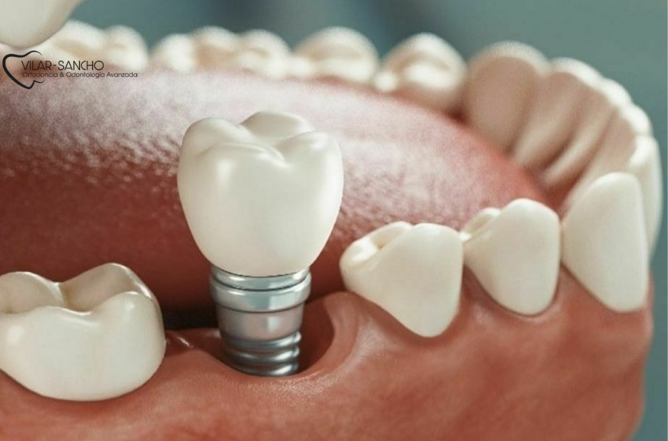 Prevención Dental en Pozuelo de Alarcón | Cuida Tu Sonrisa con Expertos Locales