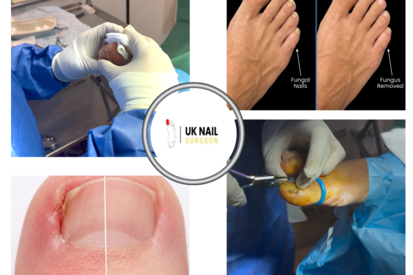 Relief for toenail troubles: expert surgical care you can trust