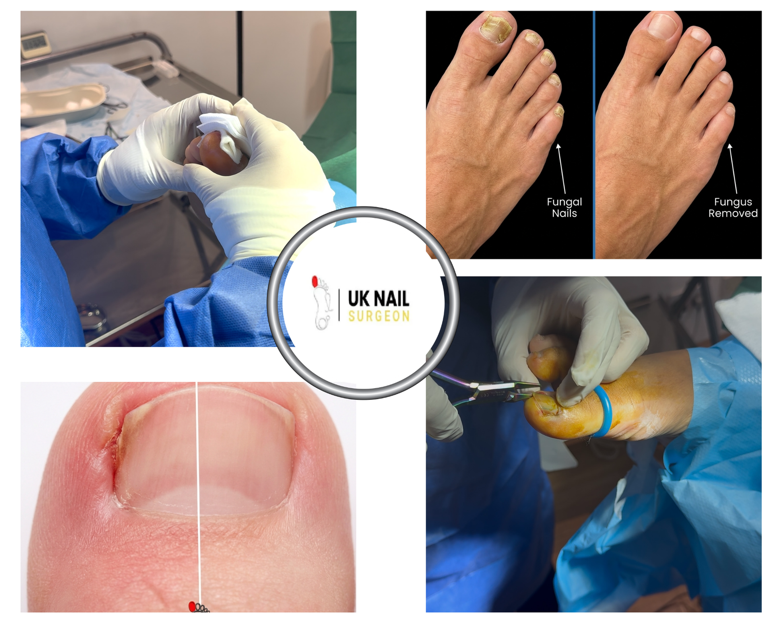 Relief for toenail troubles: expert surgical care you can trust