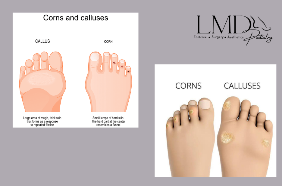 Shockwave Therapy Fort Lauderdale | Lmdpodiatry.com