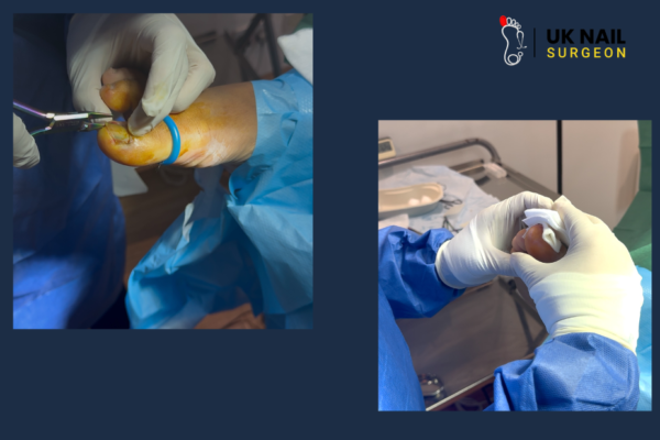 Kids Ingrown Toenail | Uk Nail Surgeon