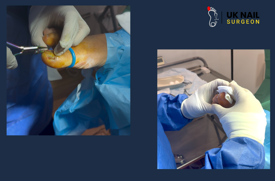 Kids Ingrown Toenail | Uk Nail Surgeon