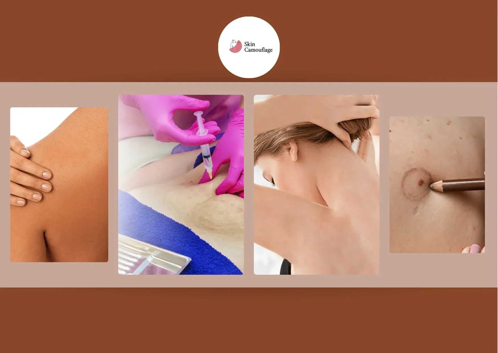 Expert Scar Tattoo Camouflage in Dubai for Natural and Lasting Results
